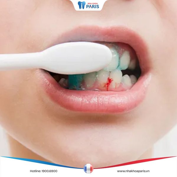 Hỏi đáp: “Đánh răng bị chảy máu thường xuyên có nguy hiểm không”