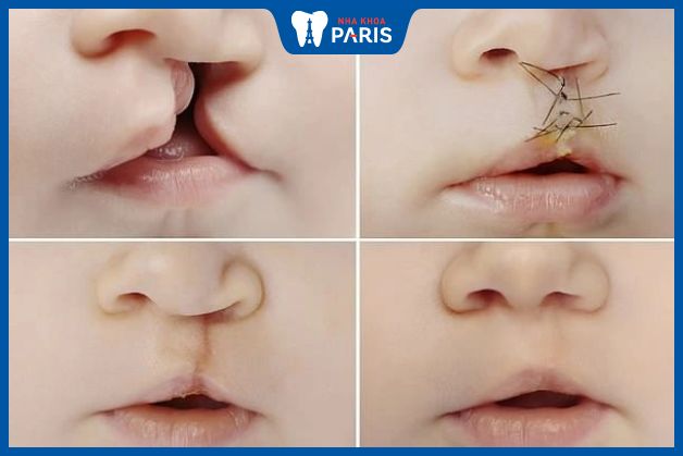 Phẫu thuật môi và vòm miệng hiện đang là cách điều trị hàm ếch