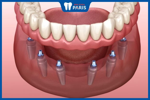 Kỹ thuật trồng răng Implant All On