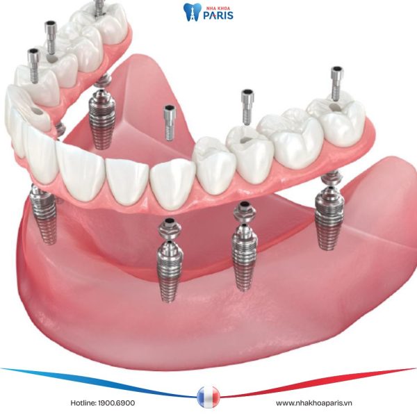 Kỹ thuật Implant All On: Giải pháp hoàn hảo cho người mất răng