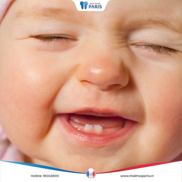 Lịch mọc răng sữa đầy đủ ở trẻ và những lưu ý quan trọng