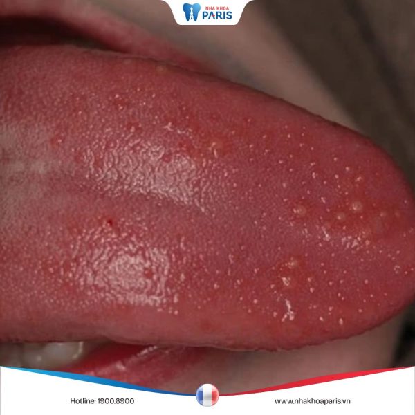 Lưỡi nổi hạt đỏ là bệnh gì? Nguyên nhân và biện pháp điều trị