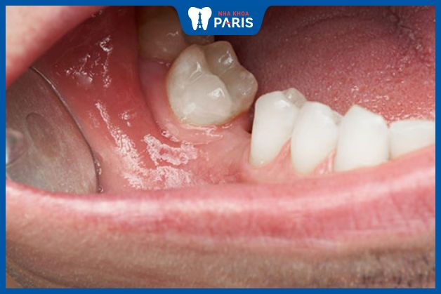 Mất răng cấm ảnh hưởng đến ăn nhai và thẩm mỹ
