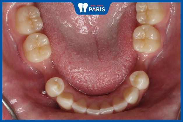 Xương hàm bị tiêu sau khi nhổ răng