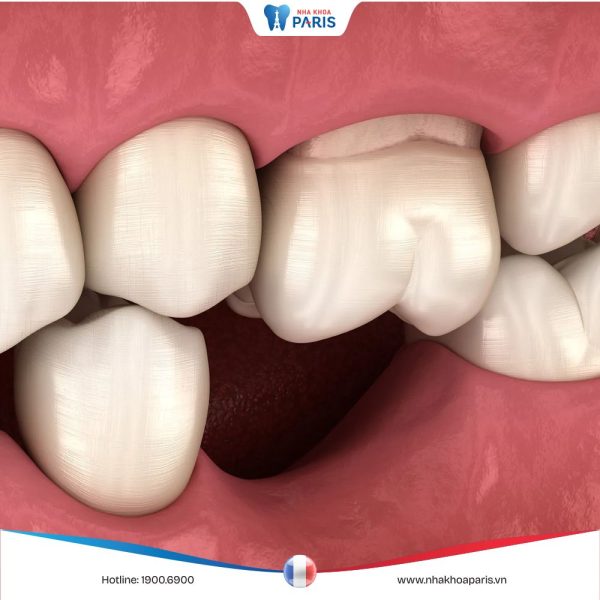 Nhổ răng bao lâu tiêu xương, biện pháp phòng tránh hiệu quả