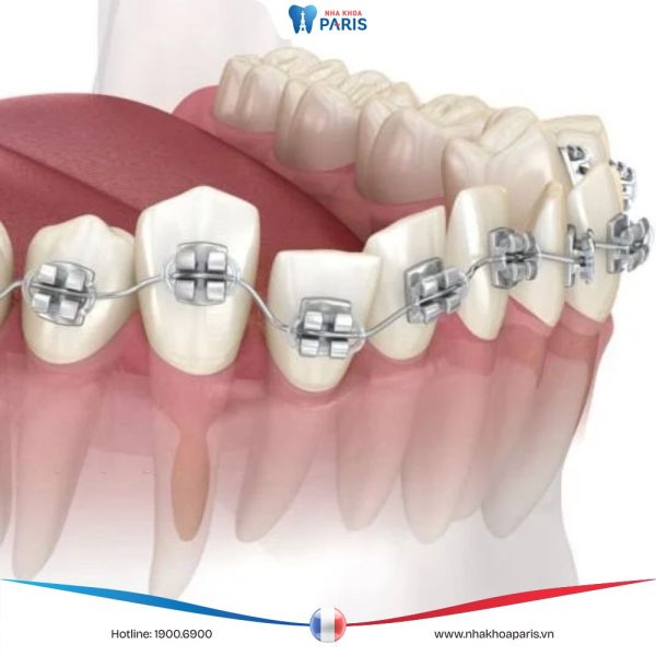 Tổng hợp những tác hại của niềng răng mà bạn nên biết