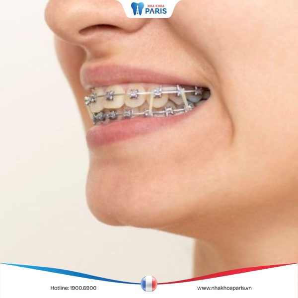 Niềng răng có tác dụng gì? Lưu ý cần biết trước khi niềng răng