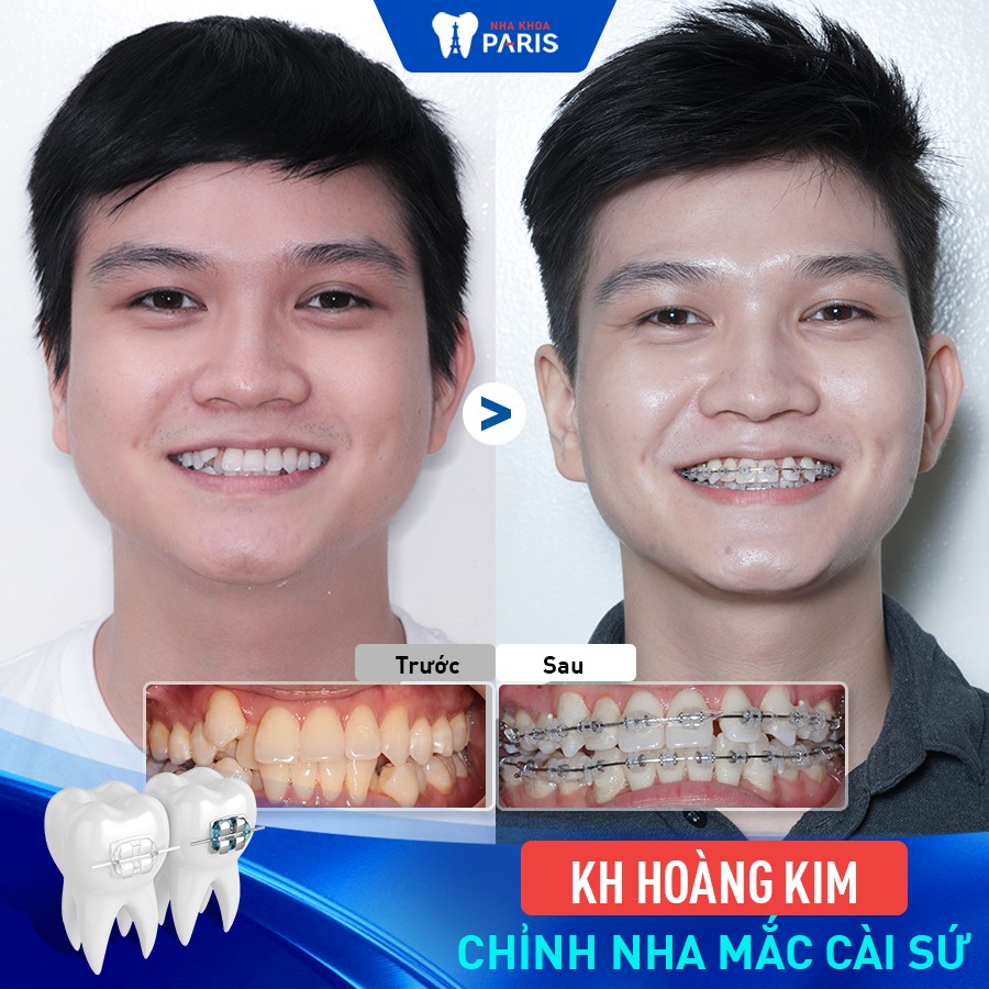 Mắc cài sứ thay đổi diện mạo hàm răng