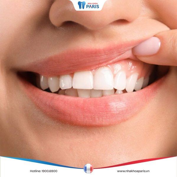 Nướu răng có tác dụng gì? Các thắc mắc liên quan đến nướu răng