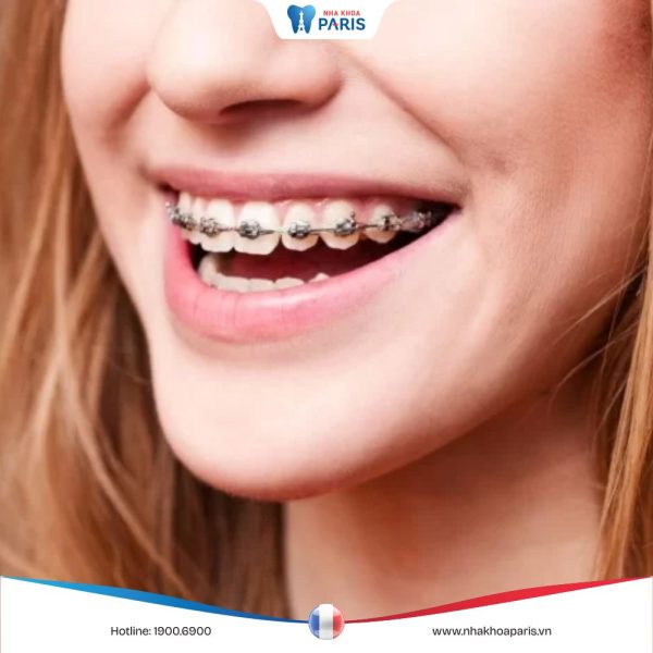 Quy trình niềng răng gồm mấy bước và những lưu ý quan trọng