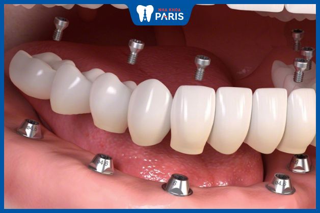 Quy trình trồng răng Implant All On