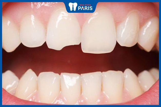 Răng sứt, mẻ là nguyên nhân dẫn đến hiện tượng chết tủy