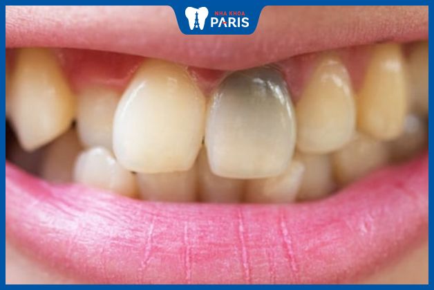 Hoại tử tủy khiến cho men răng bị đổi màu