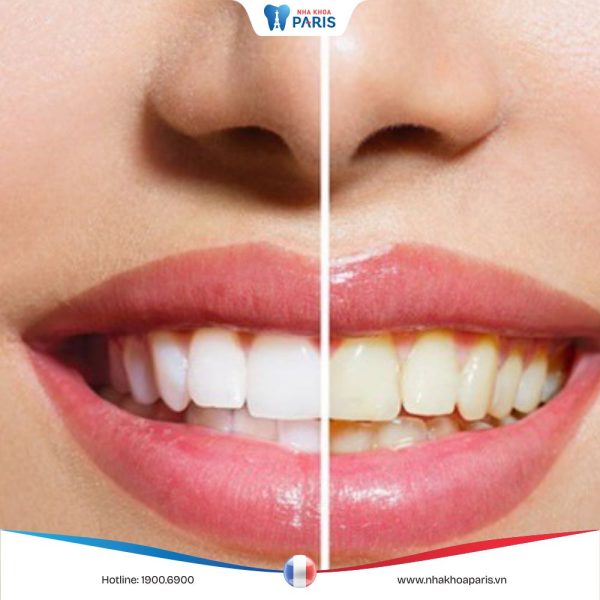 Răng đổi màu do đâu? Cách điều trị và phòng ngừa hiệu quả