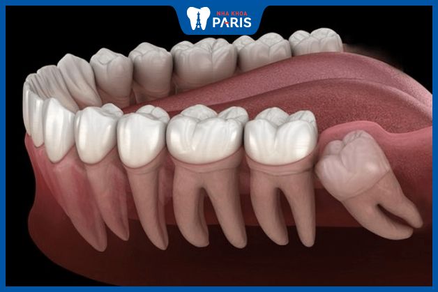 Răng khôn thuộc nhóm răng hàm lớn