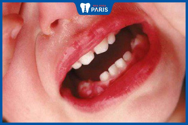 Trẻ mọc răng hàm đầu tiên từ 13 - 14 tháng tuổi