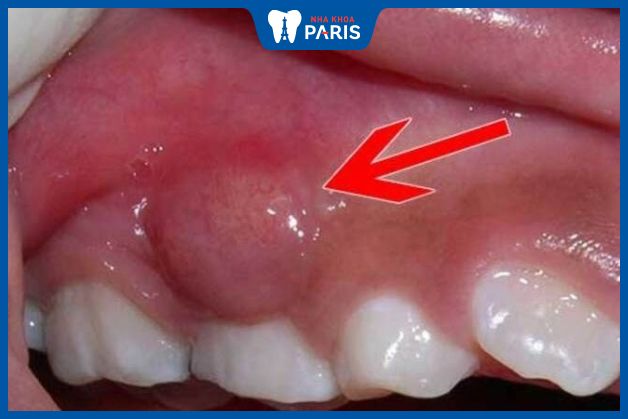 Áp xe răng là một dạng nhiễm trùng