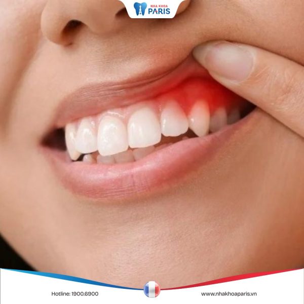 Sưng lợi răng: Nguyên nhân, triệu chứng và biện pháp điều trị