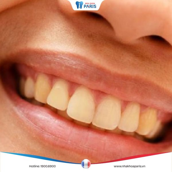 Giải đáp: Tại sao đánh răng thường xuyên mà răng vẫn vàng