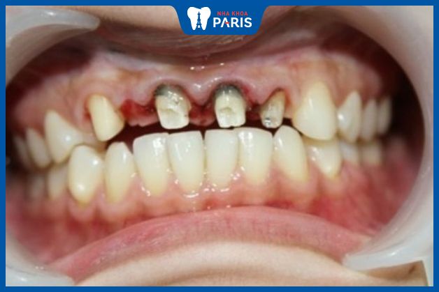 Mài răng sai kỹ thuật gây viêm tủy