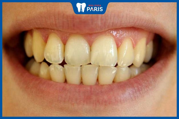 Răng vẫn có thể bị vàng lại sau khi tẩy trắng