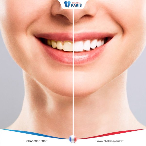 Tẩy trắng răng có bị vàng lại không? Cách giữ răng trắng lâu dài