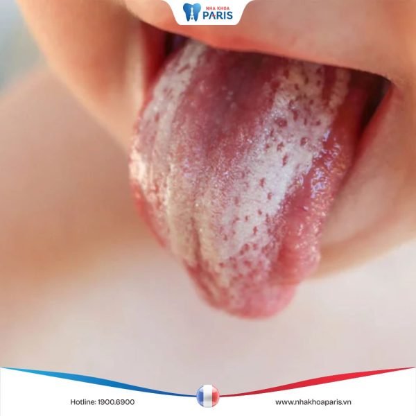 Thuốc rơ lưỡi cho trẻ sơ sinh sạch khuẩn, ngừa bệnh răng miệng