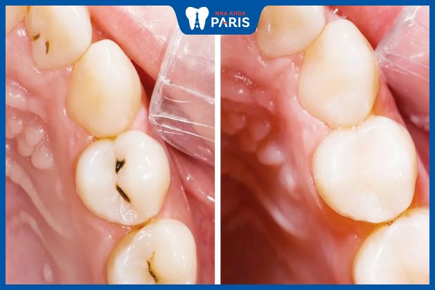 Trám răng giúp phục hồi những mô răng bị khuyết thiếu