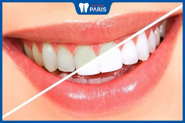 Trám men răng giúp tăng tính thẩm mỹ của hàm răng