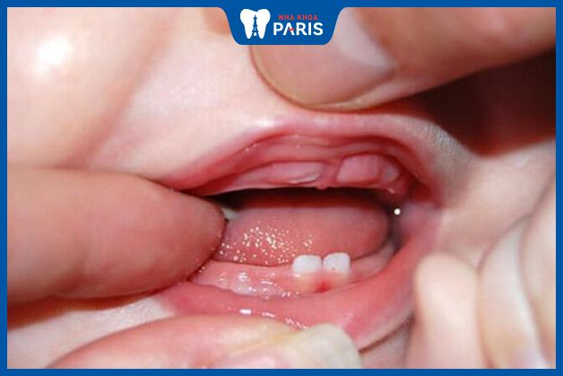 Trẻ mọc răng đầu tiên khi được 6 - 10 tháng