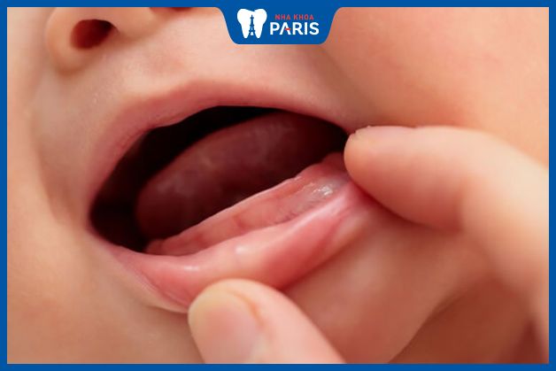 Trẻ mọc răng muộn có thể do di truyền
