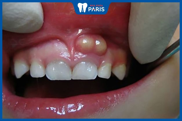Trẻ có thể bị áp xe răng do nhiều nguyên nhân khác nhau