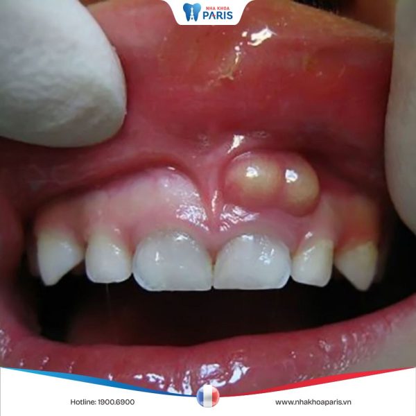 Trẻ bị áp xe nướu răng có nguy hiểm không, cách điều trị