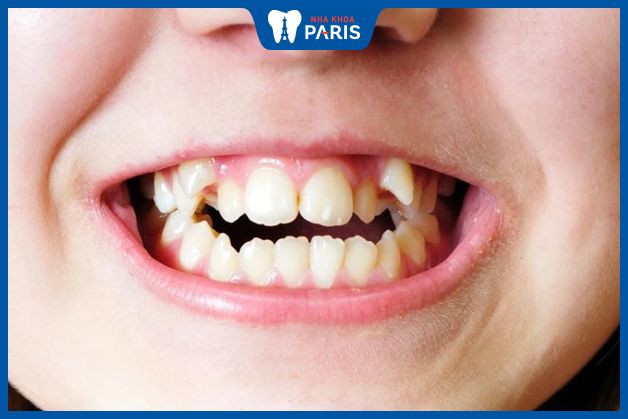 Nghiến răng có thể khiến răng mọc sai lệch