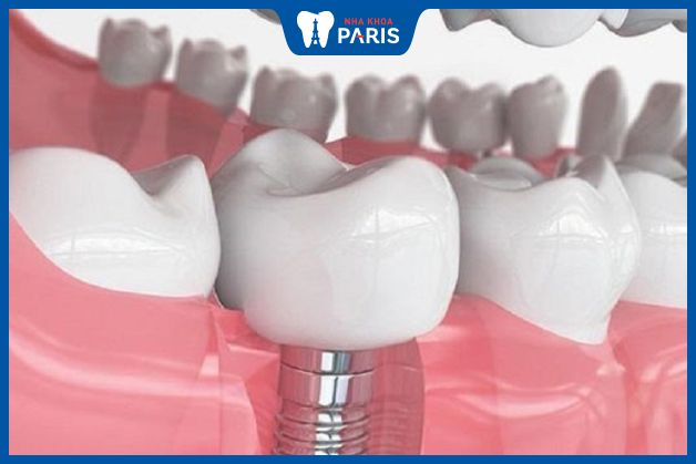 Trồng răng Implant có chi phí cao nhất
