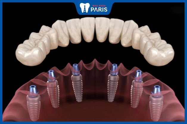 Trồng răng Implant All On 6