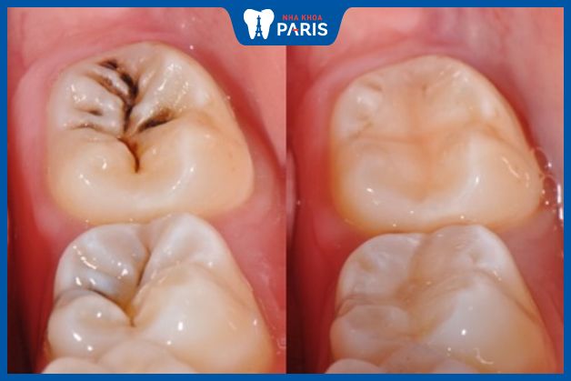 Phương pháp trám răng cho trường hợp sâu răng