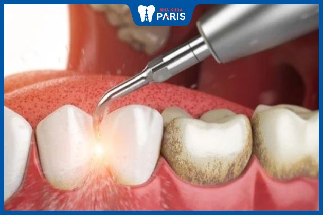 Vì sao nha sĩ khuyên nên đi khám răng định kỳ 6 tháng
