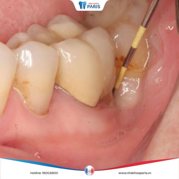 Viêm quanh thân răng cấp: Nguyên nhân, triệu chứng, cách điều trị