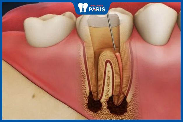 Yếu tố ảnh hưởng đến ống tủy răng ở người già