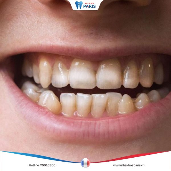 Hư men răng có cách nào điều trị không? Cách phục hồi men răng