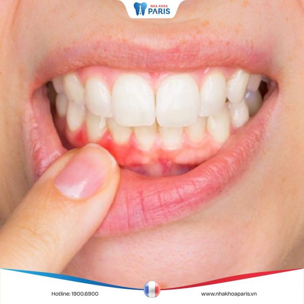 Lợi ở chân răng bị rách: Nguyên nhân, dấu hiệu và cách khắc phục