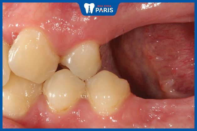 Mất răng lâu năm gây ra tình trạng tiêu xương