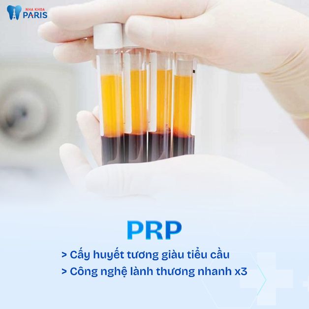 Công nghệ cấy huyết tương giàu tiểu cầu PRP - PRF