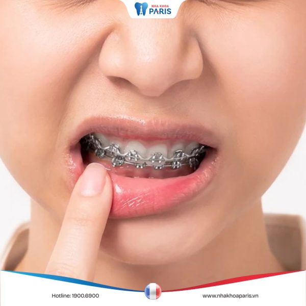 Giải đáp: Răng đau nhức lúc nhai khi niềng răng có sao không
