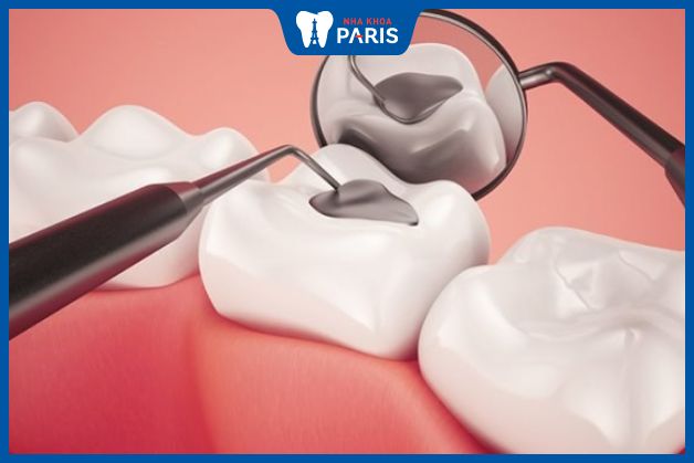 Trám răng để phục hồi men răng