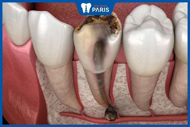 Triệu chứng của viêm tủy răng có hốc mủ