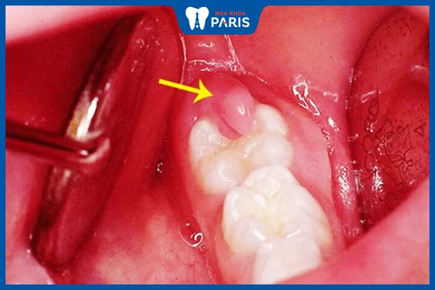 Lợi trong răng hàm khi viêm bị phình to, sưng đỏ