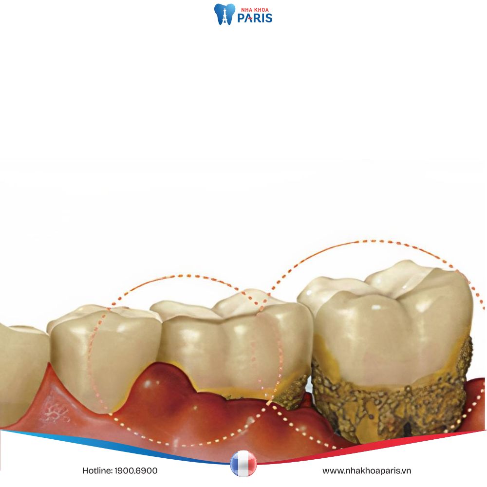 Viêm lợi răng hàm là gì? Dấu hiệu, nguyên nhân & cách chữa