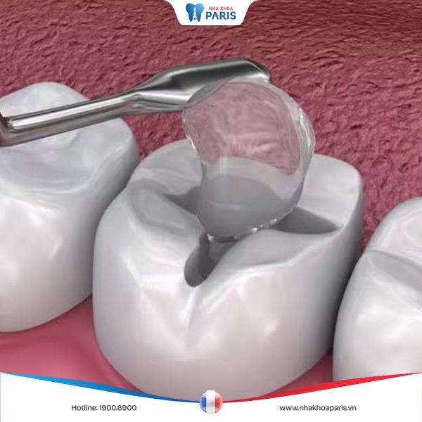 Hàn răng có đau không? Những lưu ý sau quá trình hàn trám răng